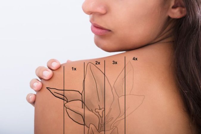 Évolution de l'effacement d'un tatouage de fleur sur l'épaule d'une femme grâce au détatouage laser.